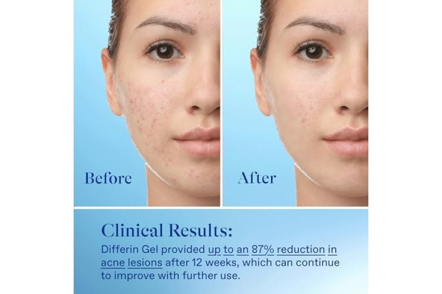 Gel para el tratamiento del acné Differin, suministro para 30 días, tratamiento con retinoides para el rostro con 0,1 % de adapaleno, cuidado suave de la piel para pieles sensibles propensas al acné, tubo de 15 g - Image 8